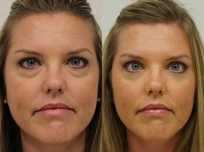 Before & After Eyelid Surgery Case 31 View #2 View in Gilbert, AZ