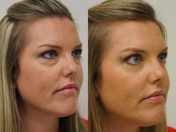 Before & After Eyelid Surgery Case 31 View #3 View in Gilbert, AZ
