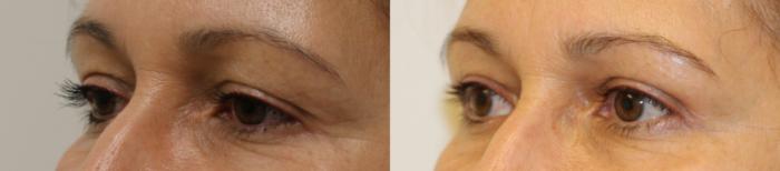 Before & After Eyelid Surgery Case 37 View #1 View in Gilbert, AZ