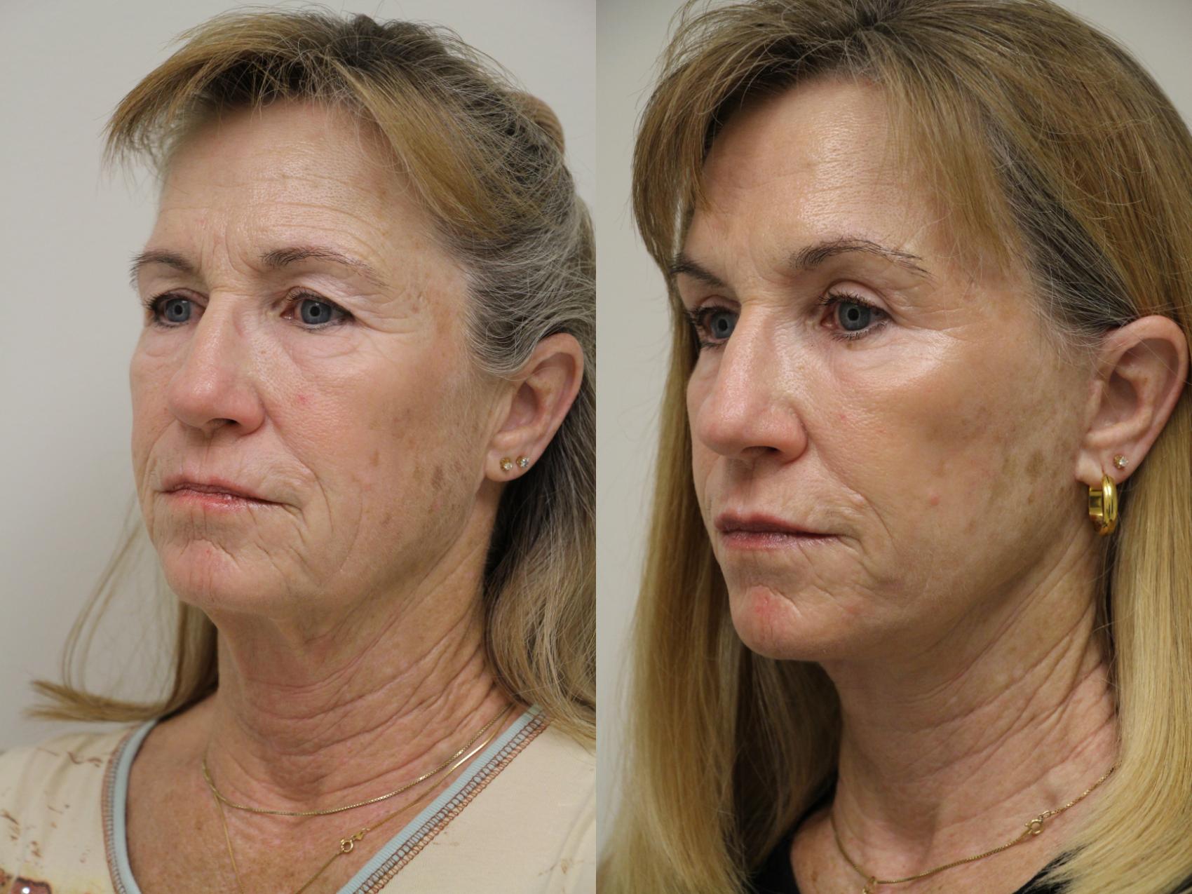 Before & After Eyelid Surgery Case 44 View #1 View in Gilbert, AZ
