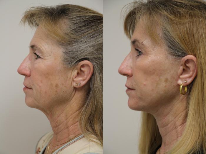 Before & After Eyelid Surgery Case 44 View #2 View in Gilbert, AZ