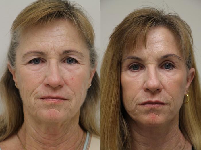 Before & After Eyelid Surgery Case 44 View #3 View in Gilbert, AZ