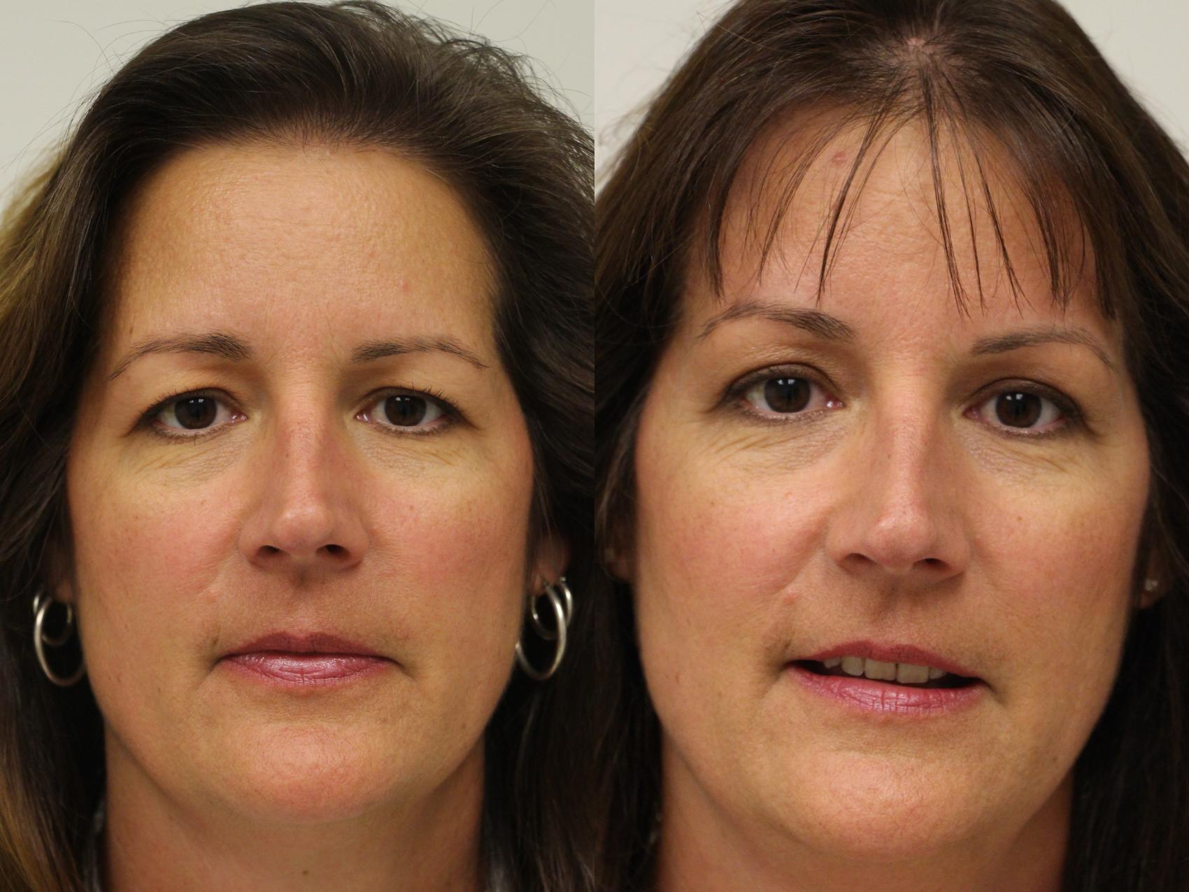 Blepharoplasty (Eyelid Surgery) in Gilbert, AZ