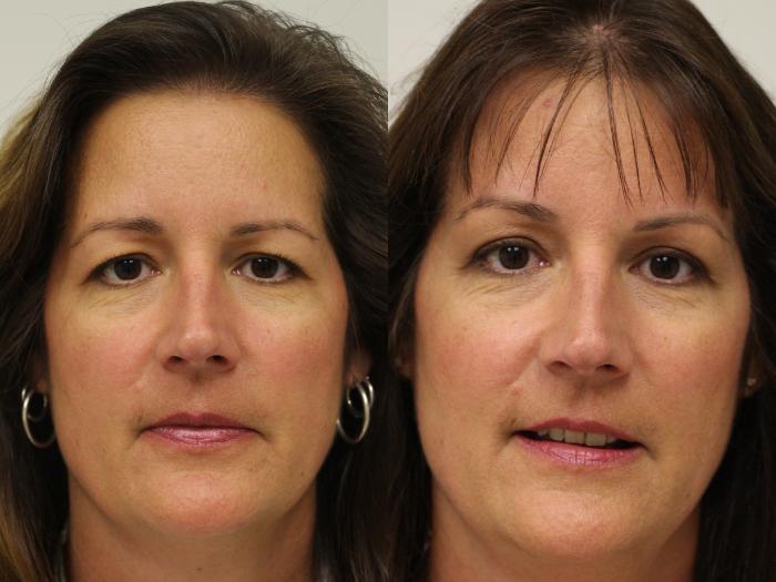 Before & After Eyelid Surgery Case 45 View #1 View in Gilbert, AZ