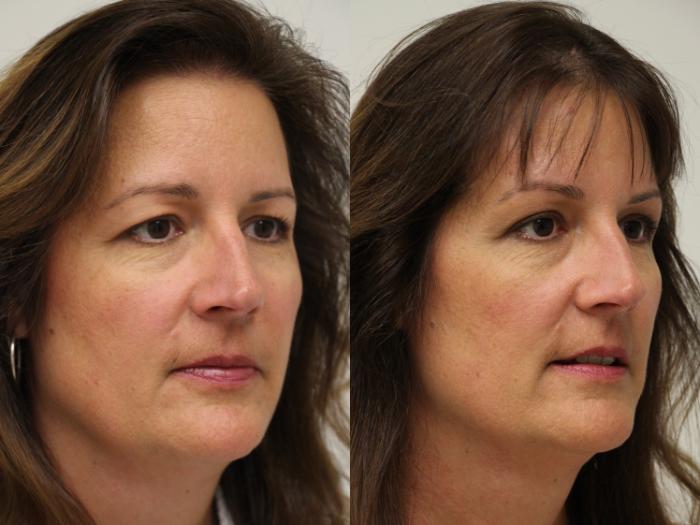 Before & After Eyelid Surgery Case 45 View #2 View in Gilbert, AZ
