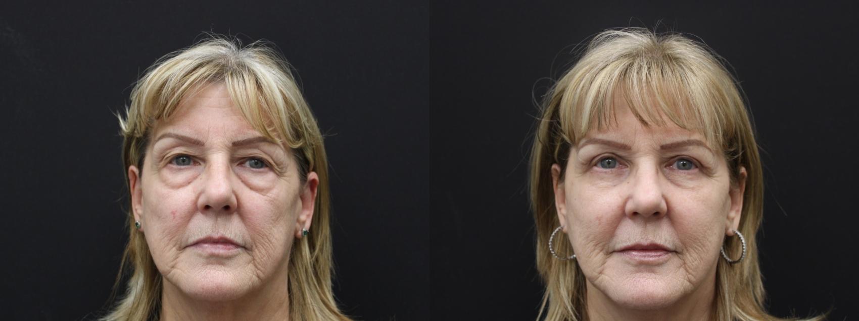 Before & After Eyelid Surgery Case 463 Front View in Gilbert, AZ