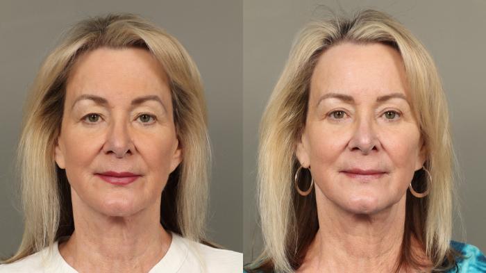 Before & After Eyelid Surgery Case 472 Front View in Gilbert, AZ