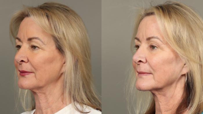 Before & After Eyelid Surgery Case 472 Left Oblique View in Gilbert, AZ