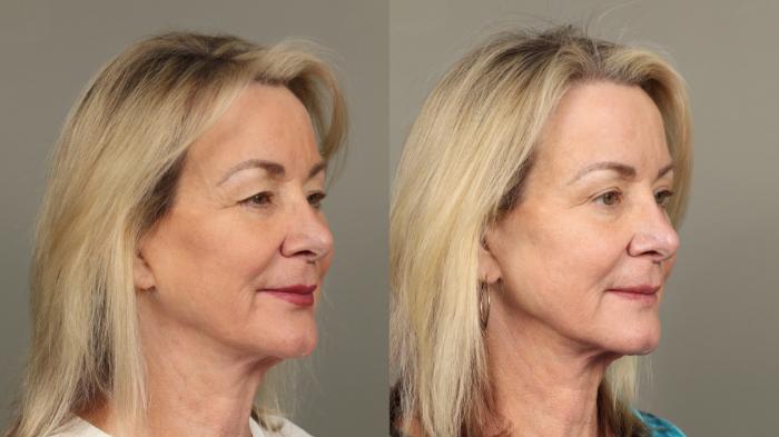 Before & After Eyelid Surgery Case 472 Right Oblique View in Gilbert, AZ