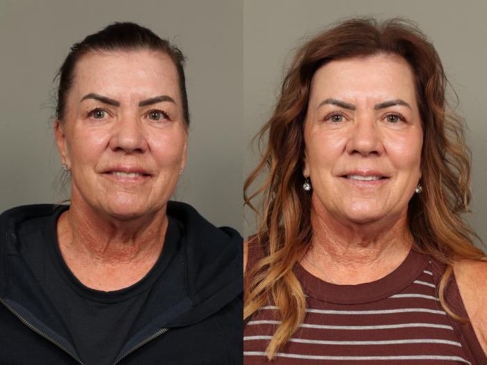 Before & After Eyelid Surgery Case 478 Front View in Gilbert, AZ
