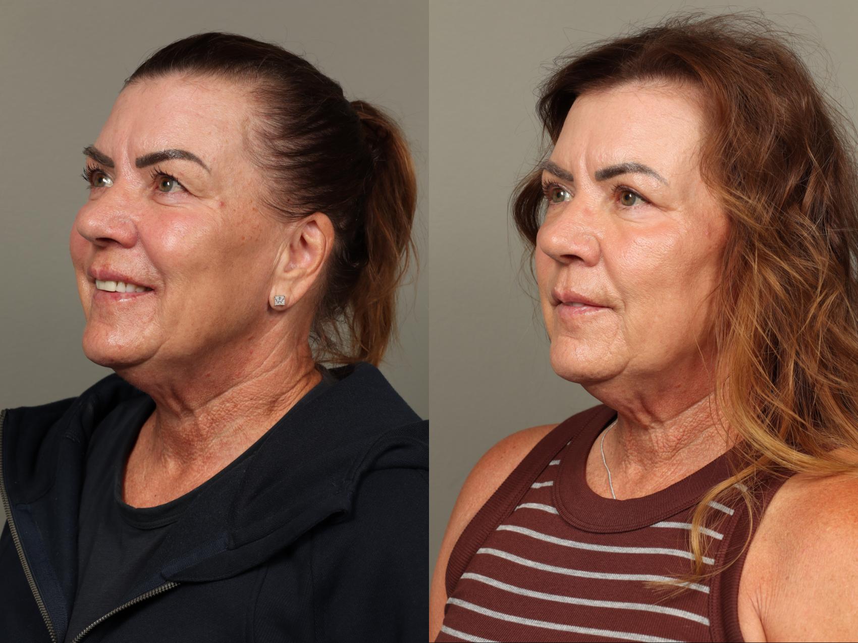 Before & After Eyelid Surgery Case 478 Left Side View in Gilbert, AZ