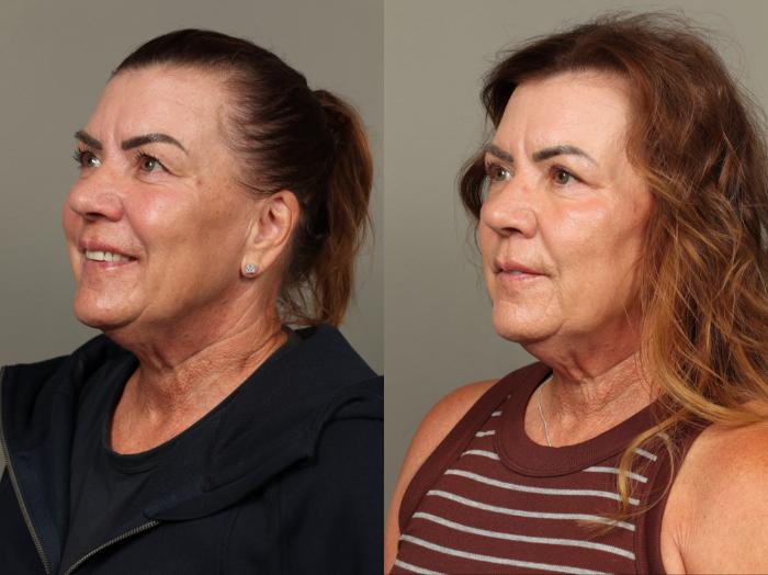 Before & After Eyelid Surgery Case 478 Left Side View in Gilbert, AZ