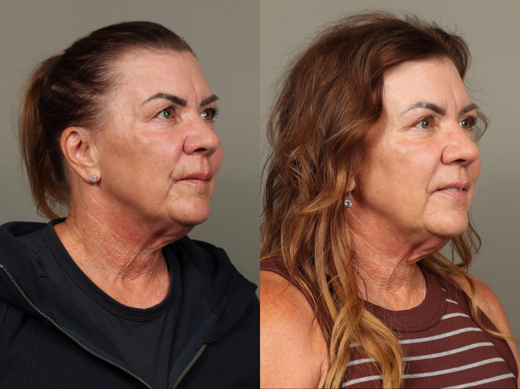 Before & After Eyelid Surgery Case 478 Right Oblique View in Gilbert, AZ
