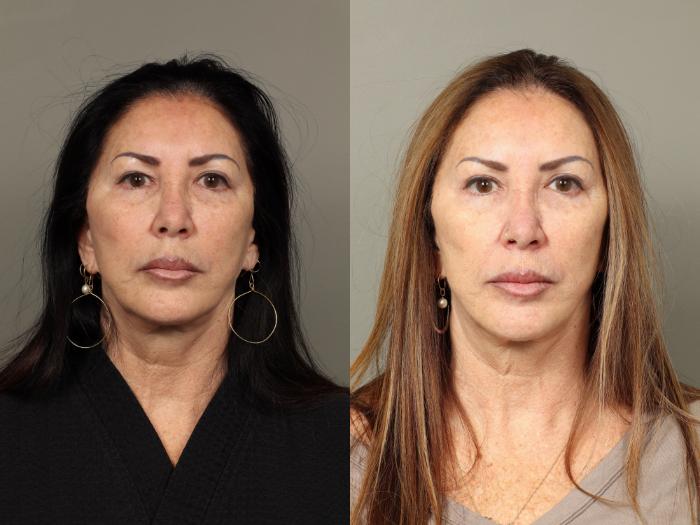 Before & After Eyelid Surgery Case 481 Front View in Gilbert, AZ