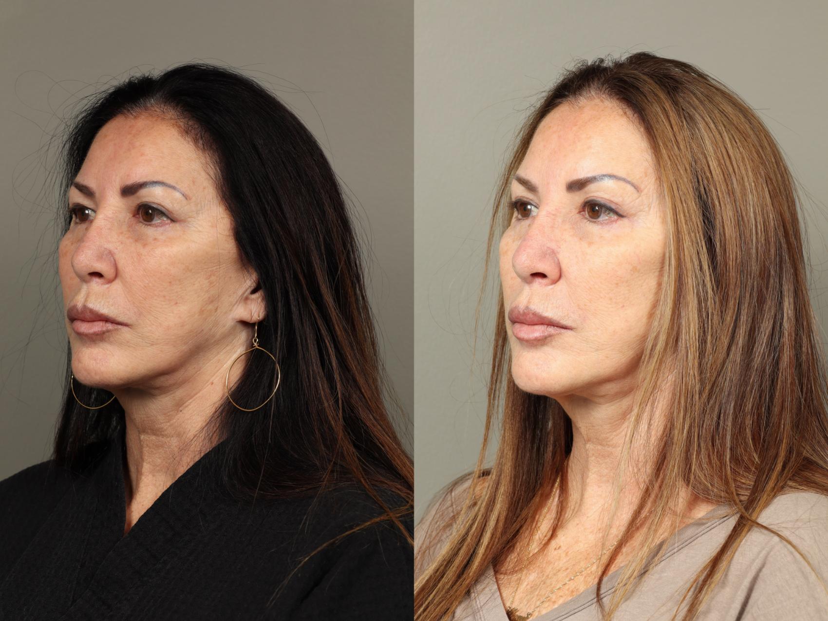 Before & After Eyelid Surgery Case 481 Left Oblique View in Gilbert, AZ