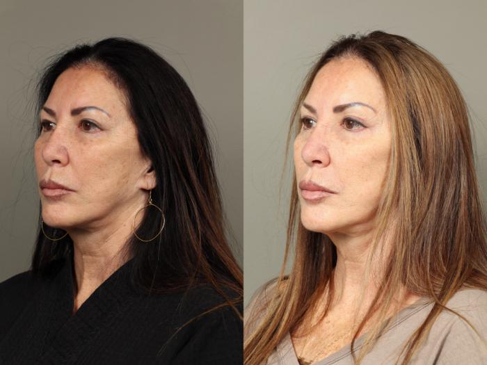 Before & After Eyelid Surgery Case 481 Left Oblique View in Gilbert, AZ