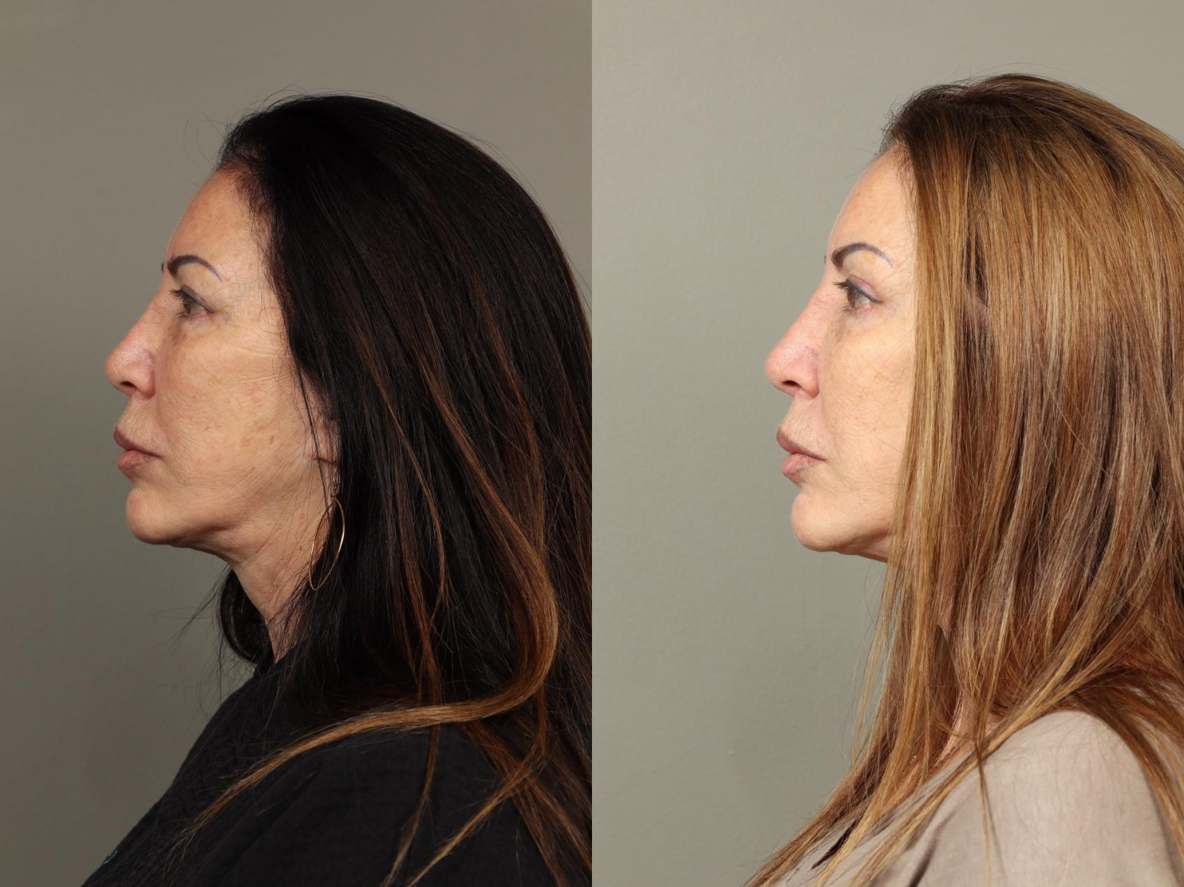 Before & After Eyelid Surgery Case 481 Left Side View in Gilbert, AZ