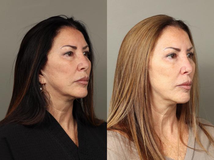 Before & After Eyelid Surgery Case 481 Right Oblique View in Gilbert, AZ