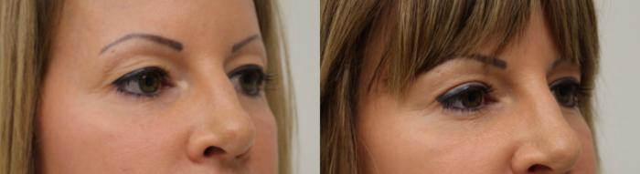 Before & After Eyelid Surgery Case 59 View #1 View in Gilbert, AZ