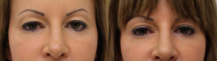 Before & After Eyelid Surgery Case 59 View #2 View in Gilbert, AZ