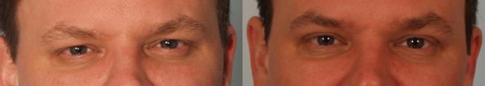 Before & After Eyelid Surgery Case 64 View #1 View in Gilbert, AZ