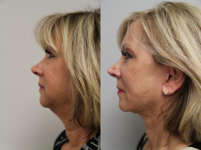 Before & After Facelift Case 110 View #3 View in Gilbert, AZ