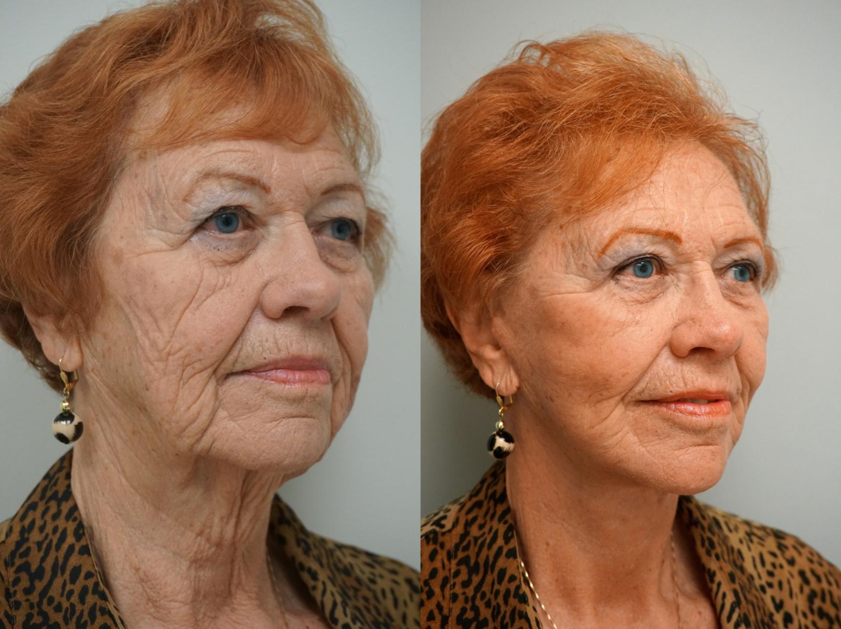Before & After Facelift Case 111 View #1 View in Gilbert, AZ