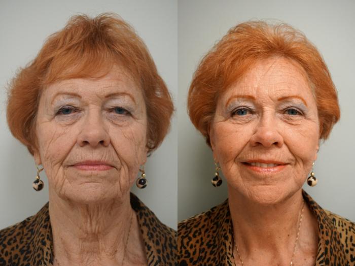 Before & After Facelift Case 111 View #2 View in Gilbert, AZ