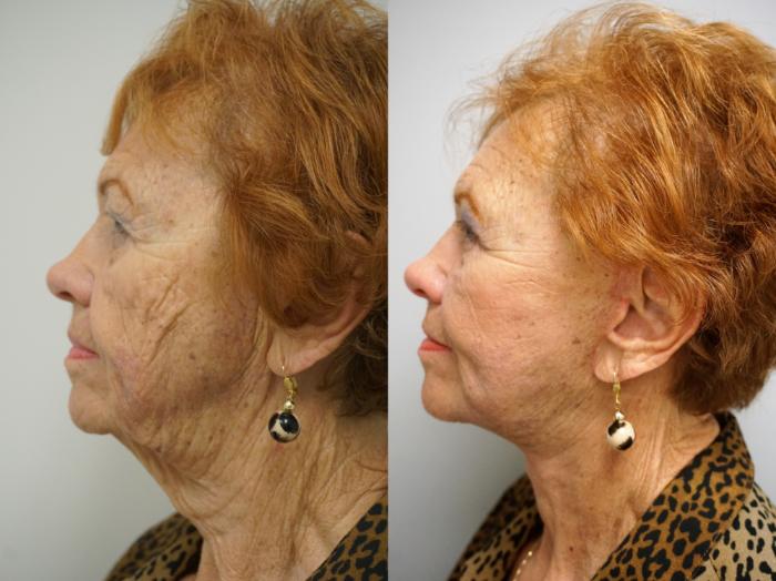 Before & After Facelift Case 111 View #3 View in Gilbert, AZ