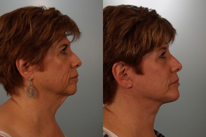 Before & After Facelift Case 152 View #1 View in Gilbert, AZ