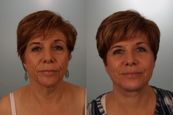 Before & After Facelift Case 152 View #3 View in Gilbert, AZ