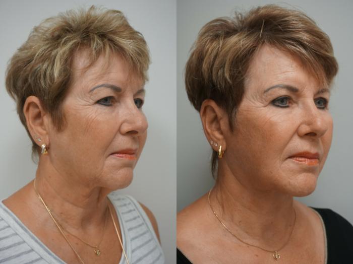 Before & After Facelift Case 217 View #1 View in Gilbert, AZ
