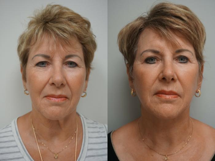 Before & After Facelift Case 217 View #2 View in Gilbert, AZ