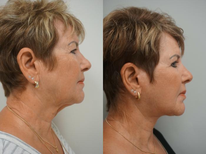 Before & After Facelift Case 217 View #3 View in Gilbert, AZ