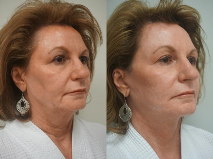 Before & After Facelift Case 251 View #1 View in Gilbert, AZ