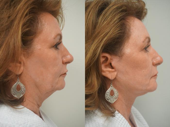 Before & After Facelift Case 251 View #2 View in Gilbert, AZ