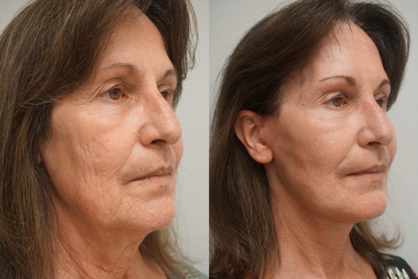 Before & After Facelift Case 299 Left Side View in Gilbert, AZ