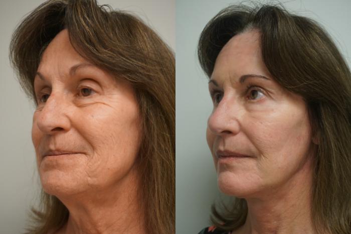 Before & After Laser Skin Resurfacing  Case 299 Right Side View in Gilbert, AZ