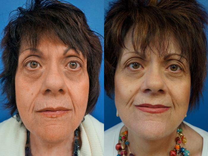 Before & After Facelift Case 3 View #1 View in Gilbert, AZ