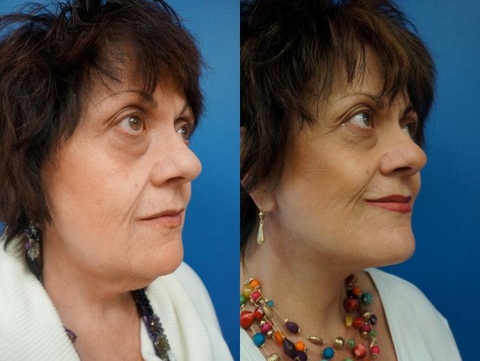 Before & After Facelift Case 3 View #2 View in Gilbert, AZ