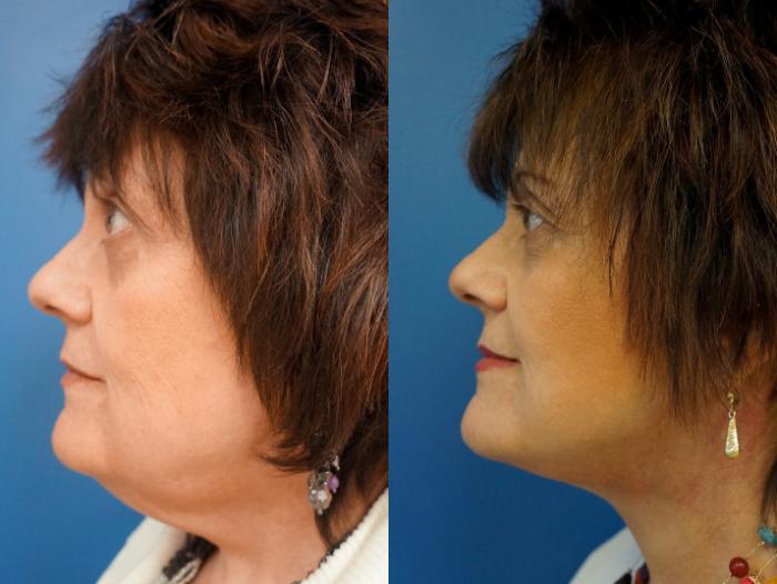 Before & After Facelift Case 3 View #3 View in Gilbert, AZ