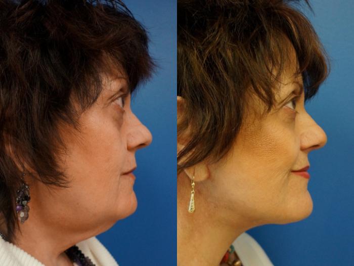 Before & After Facelift Case 3 View #4 View in Gilbert, AZ