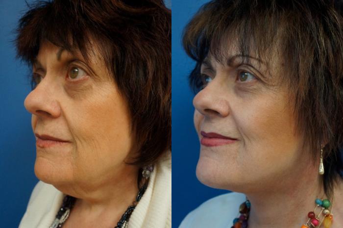 Before & After Facelift Case 3 View #5 View in Gilbert, AZ