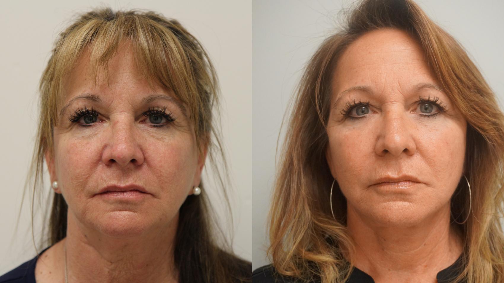 Before & After Facelift Case 303 Front View in Gilbert, AZ