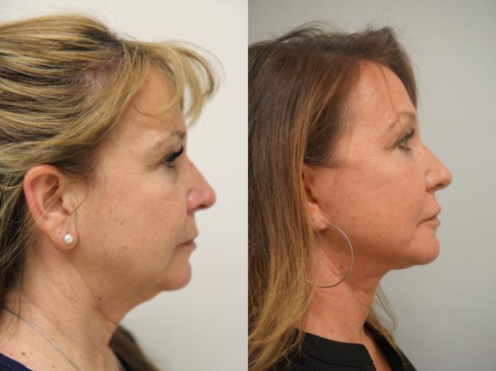 Before & After Eyelid Surgery Case 303 Right Side View in Gilbert, AZ