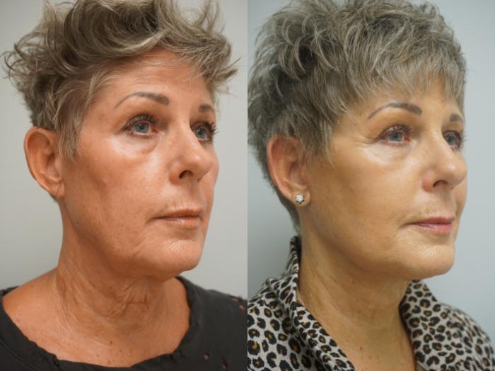 Before & After Facelift Case 304 Right Oblique View in Gilbert, AZ