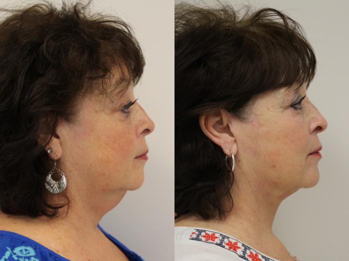 Before & After Facelift Case 43 View #1 View in Gilbert, AZ