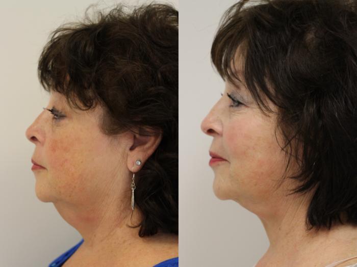Before & After Facelift Case 43 View #3 View in Gilbert, AZ