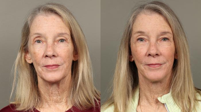 Before & After Eyelid Surgery Case 447 Front View in Gilbert, AZ