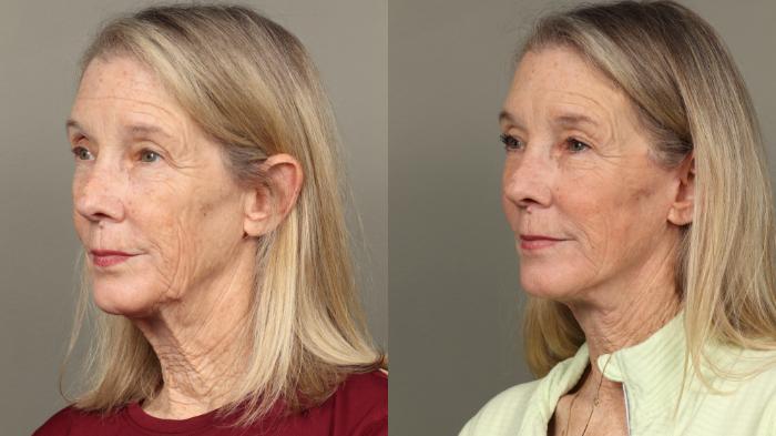 Before & After Facelift Case 447 Left Oblique View in Gilbert, AZ